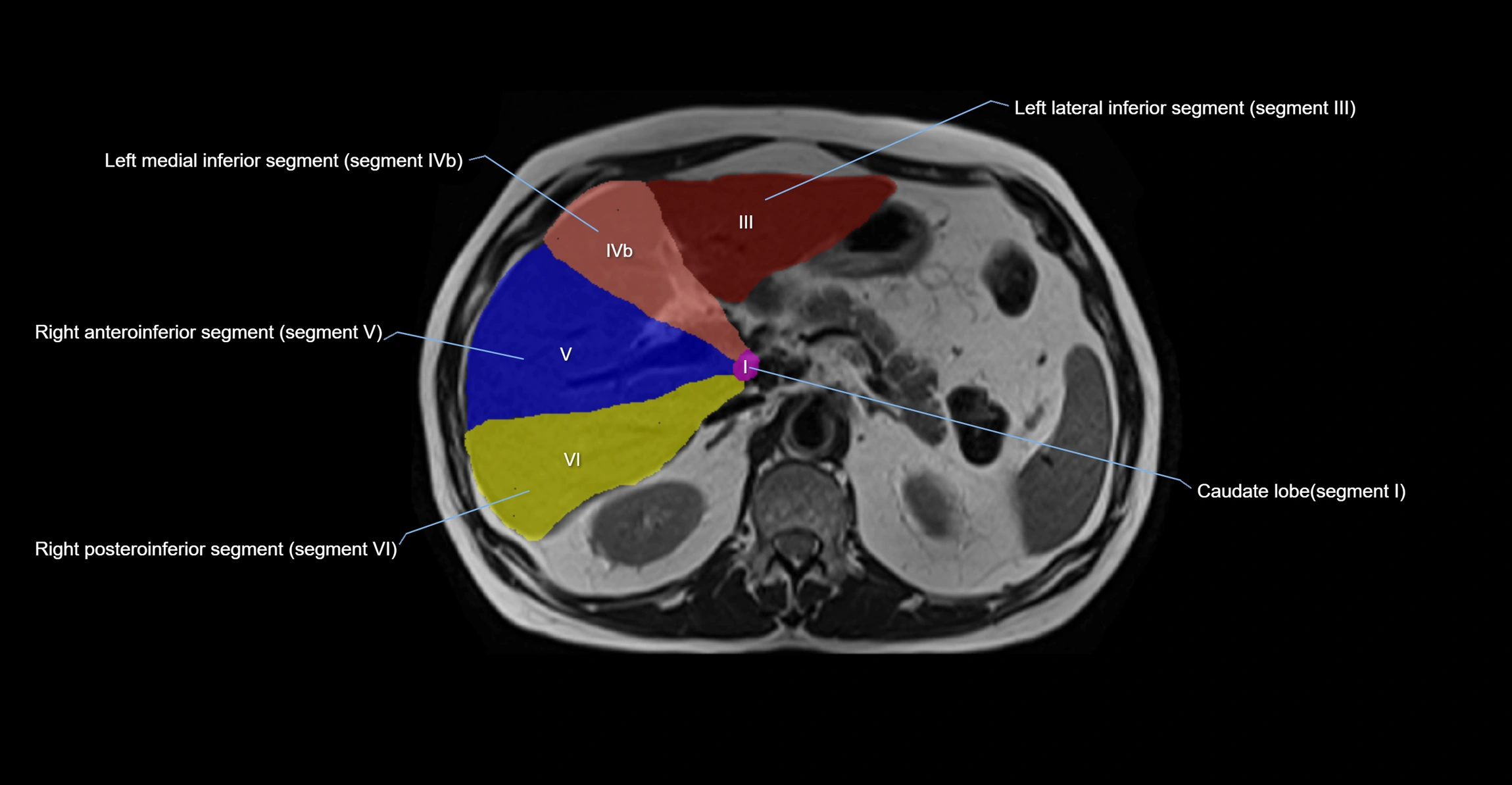 MRI  liver segments anatomy axial cross sectional 3T radiology  image-img-00001-00015.webp